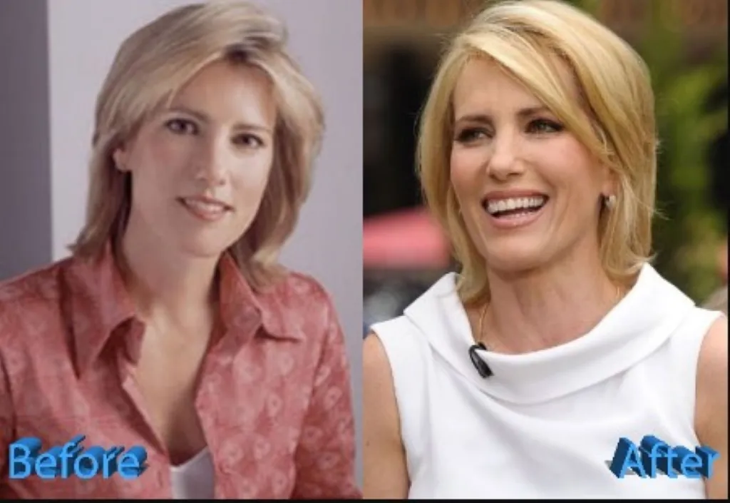 Did Laura Ingraham Get Plastic Surgery? TV Host Before And After Picture!